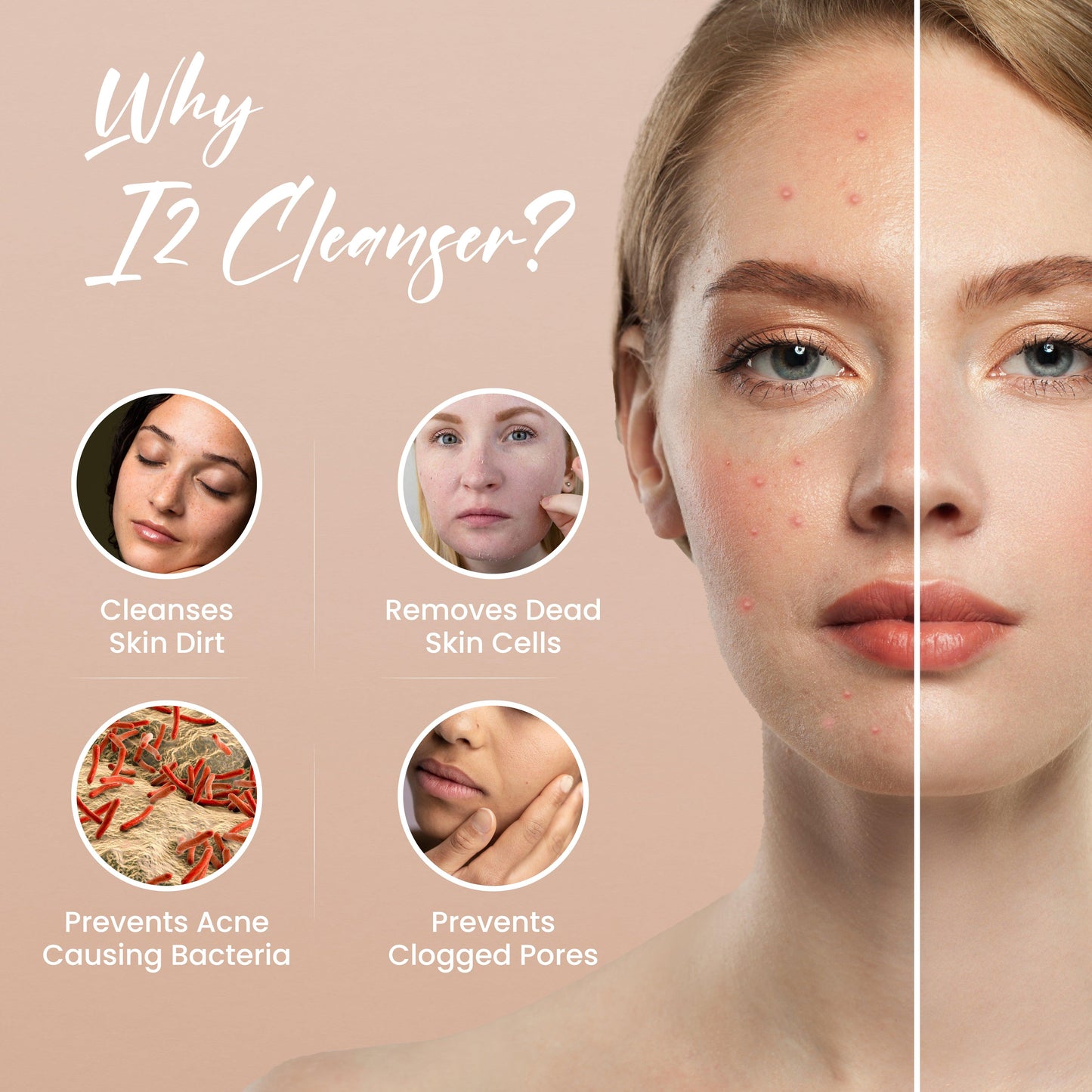 Acne Cleanser (50ml)